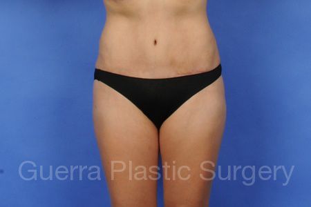 prev Case #4047 After