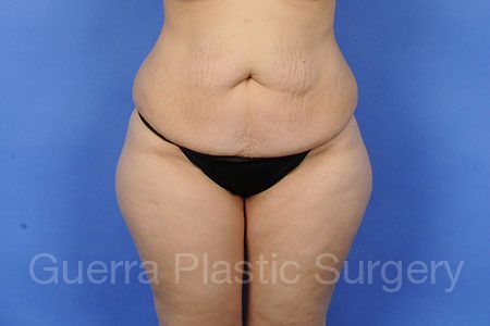 next Case #6378 Before