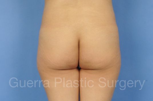 Before Photo Brazilian Butt Lift