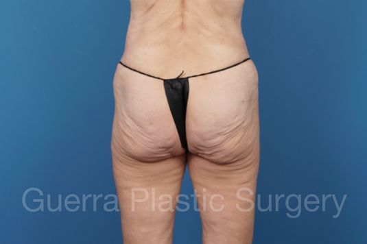 Before Photo Brazilian Butt Lift