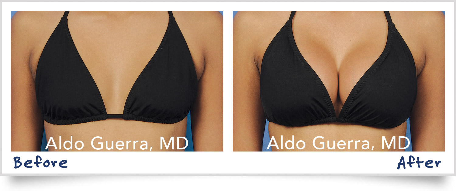 Breast augmentation natural Scottsdale Phoenix Arizona Tempe