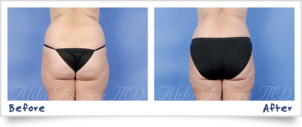 tummy tuck before and after photo