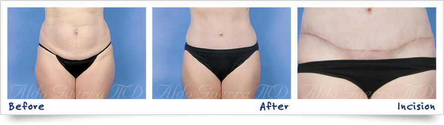 before and after photo of tummy tuck with Insorb