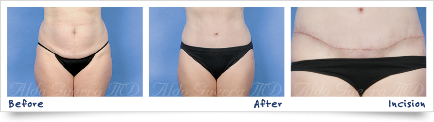 tummy tuck before and after photos