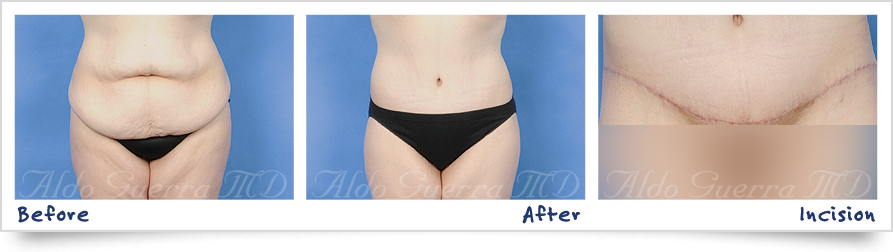 before and after photo of tummy tuck with dermabond
