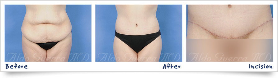 tummy tuck before and after photo