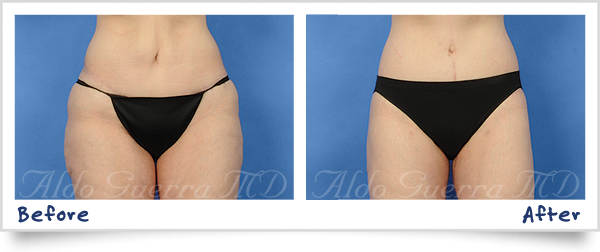 tummy tuck before and after photo