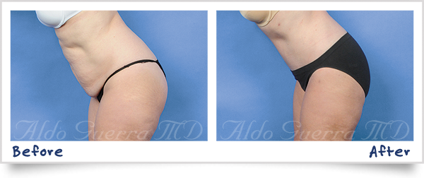 tummy tuck before and after photo