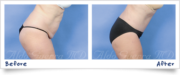 tummy tuck before and after photo