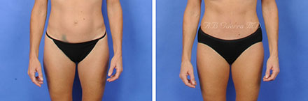 mini tummy tuck before and after photo