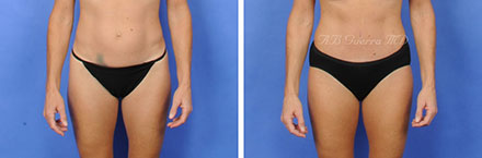 tummy tuck before and after photo