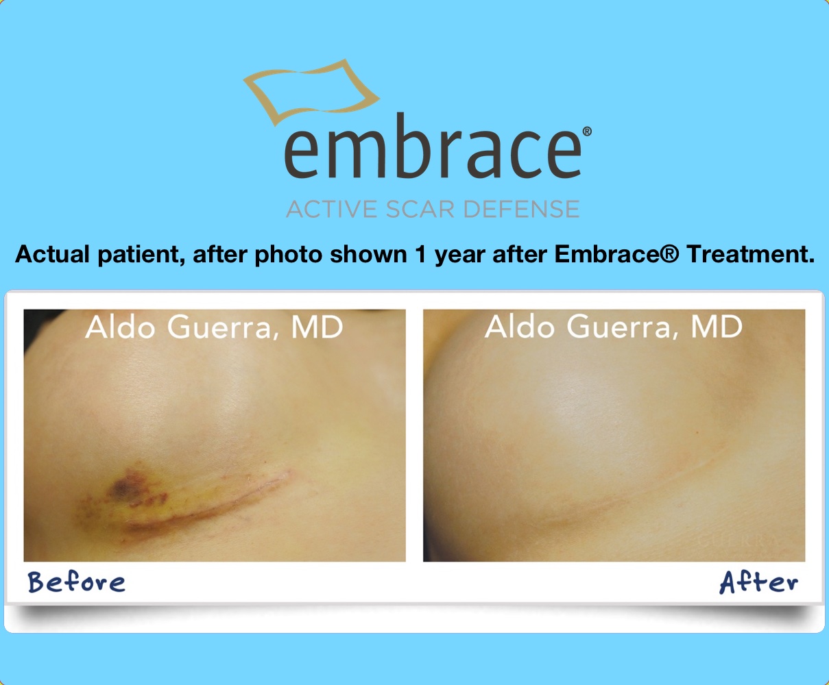 Actual patient, Embrace before and after 1 year photo