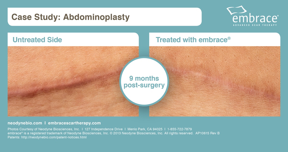 embrace tummy tuck before and after photo courtesy of Neodyne Biosciences, Inc.