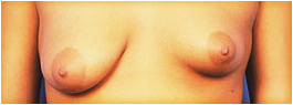 asymmetrical breasts photo