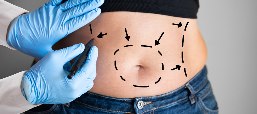 Understanding the Four Types of Tummy Tuck in Scottsdale, AZ