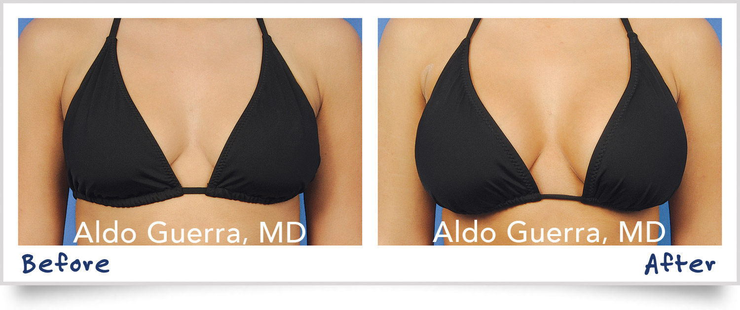 breast lift before after