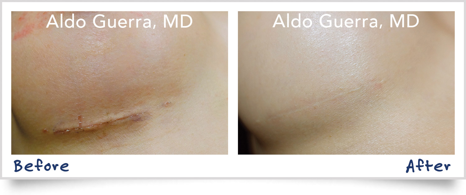 #1 Scar Therapy Treatment embrace® for Breast Augmentation and Tummy Tuck Incisions