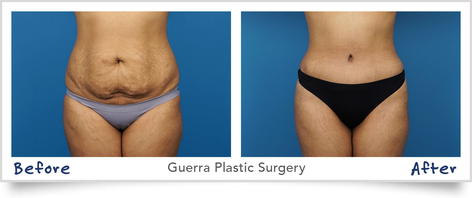Is 24-Hour Liposuction Real or Exaggerated?