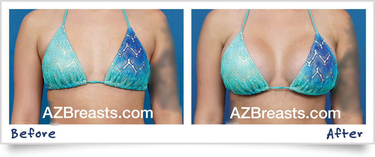 Best Bras after Breast Augmentation - Scottsdale, AZ