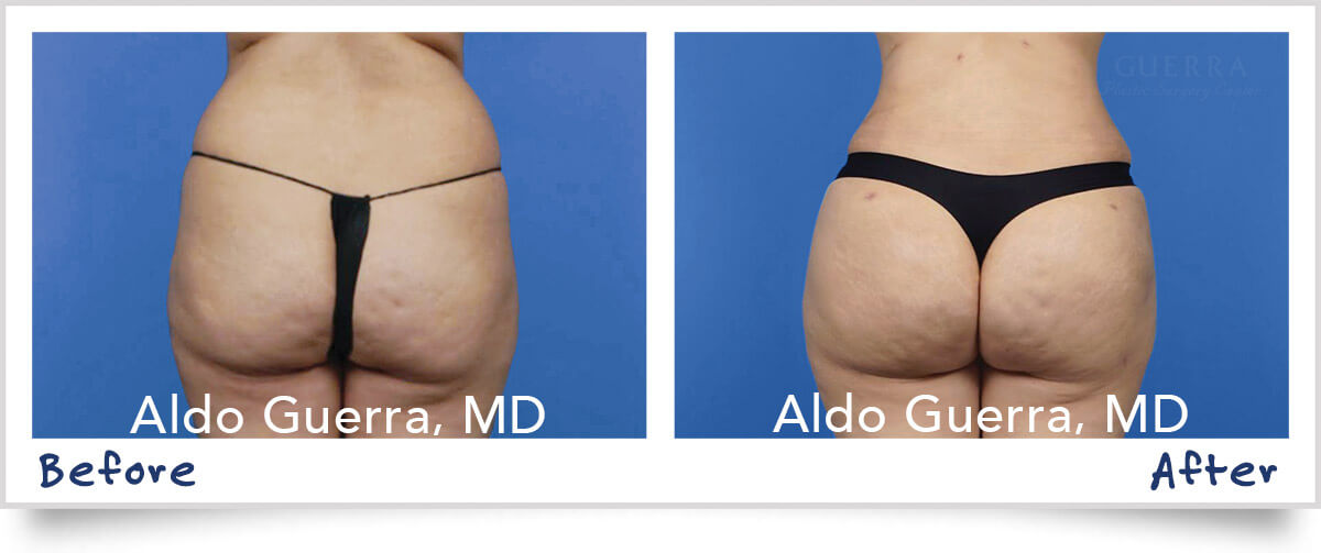Any new advancements in Liposuction?