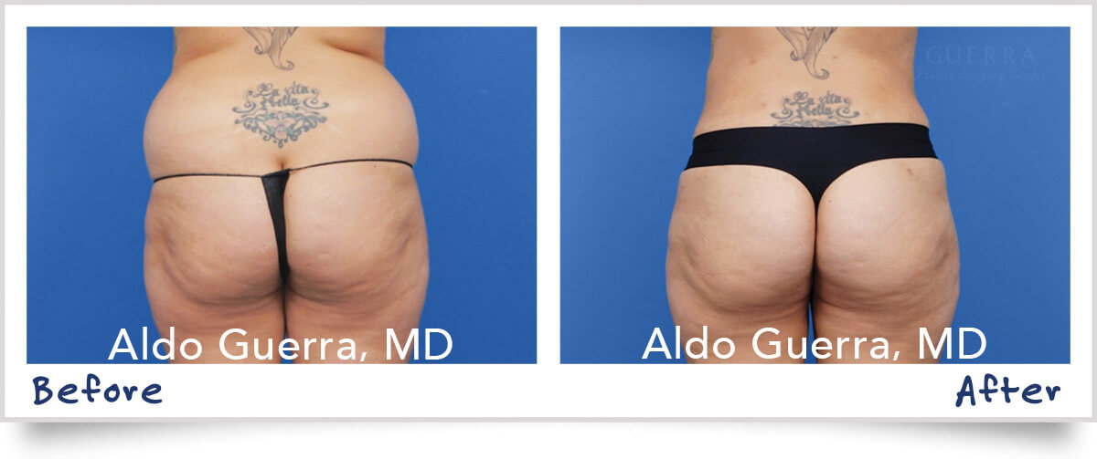 What are the Advantages of Power Assisted Liposuction?