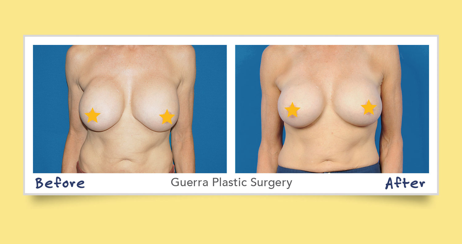 7 Signs You Need Breast Revision Surgery in Scottsdale AZ