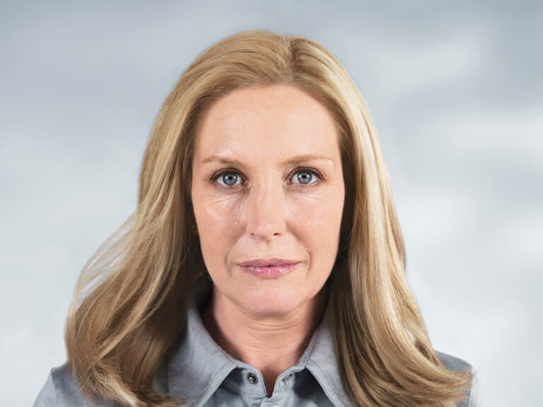 Elissa before Sculptra sculptra before photo elissa