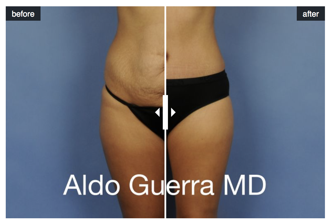 tummy tuck results