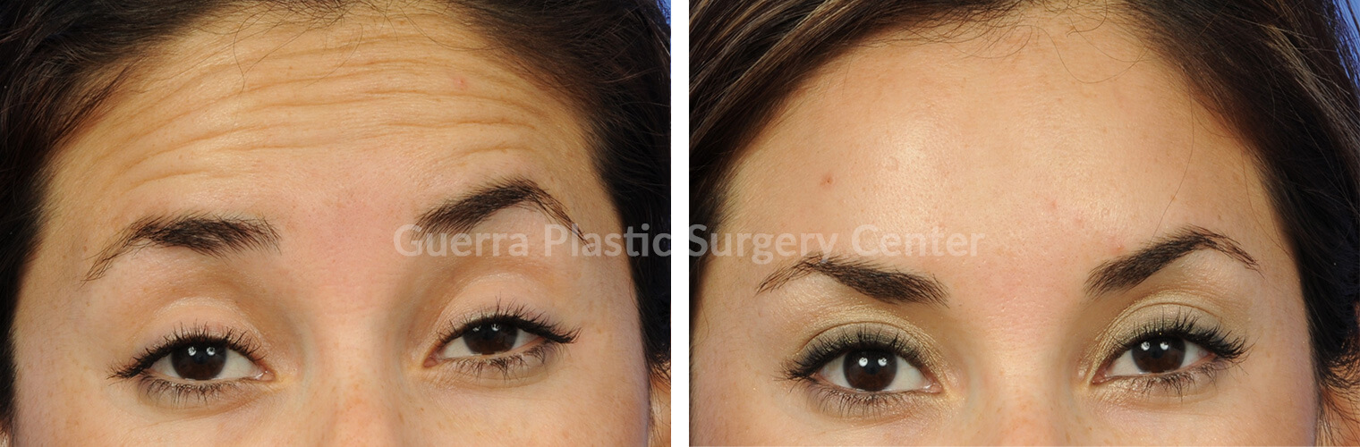 8 Reasons Women Love BOTOX® (Even Men, Too!)