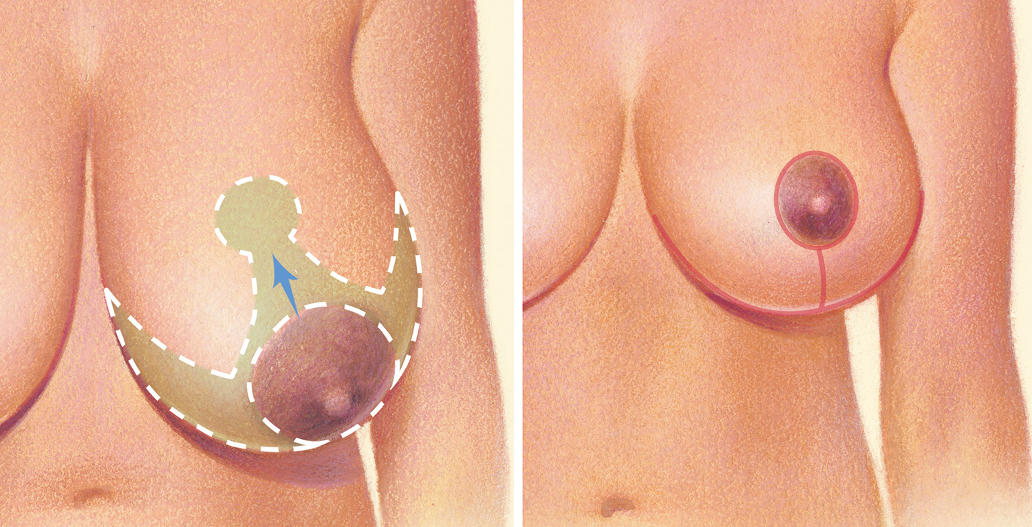 breast reduction before after