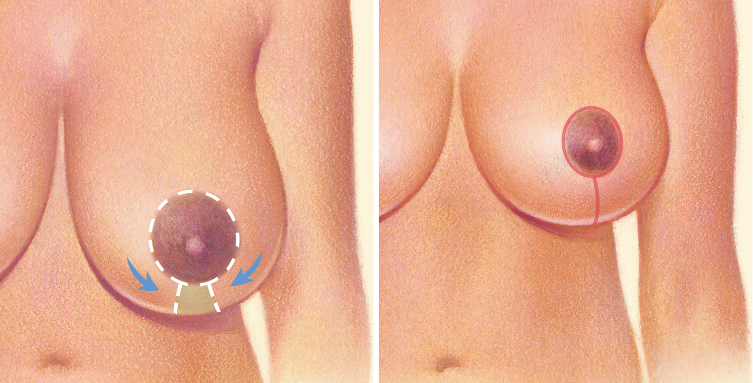 diagram of breast lift