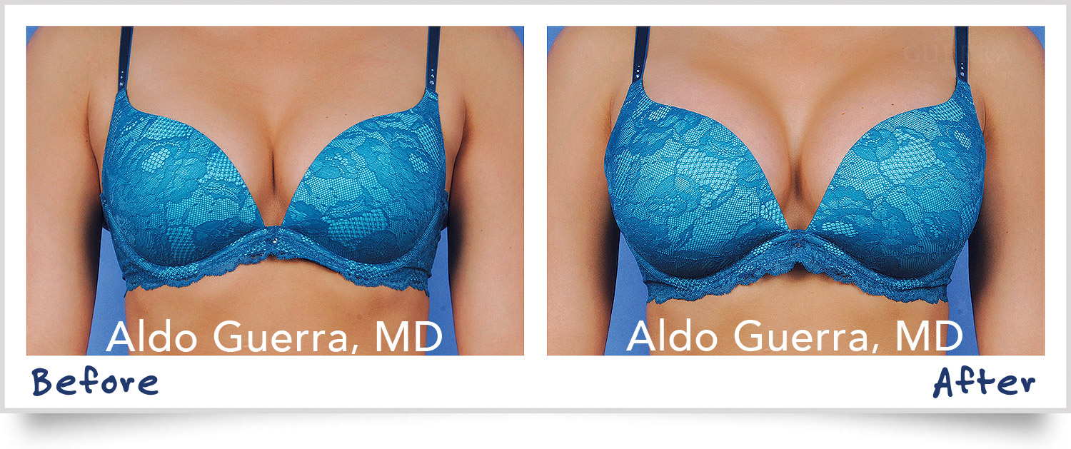 before after breast augmentation