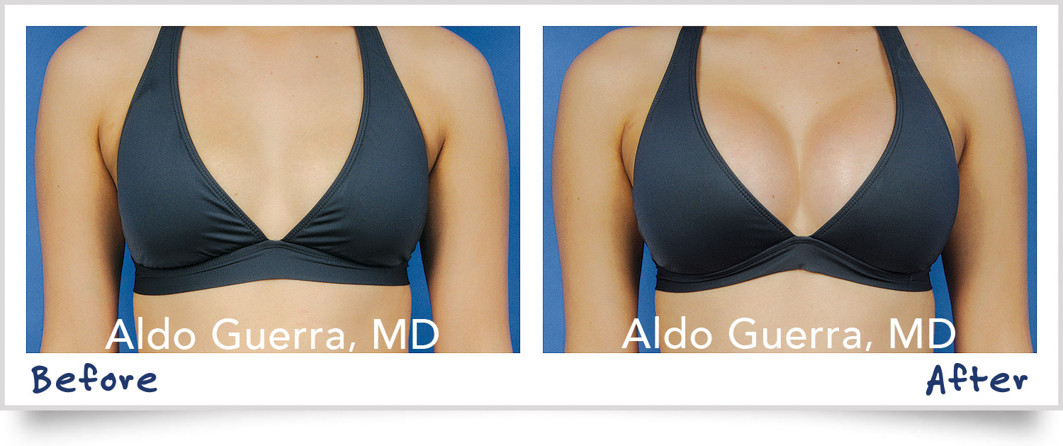 before after breast augmentation