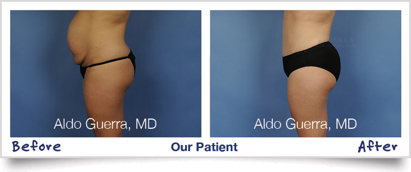 tummy tuck before after photo