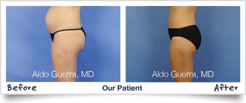 Arizona Tummy Tuck Procedure Results