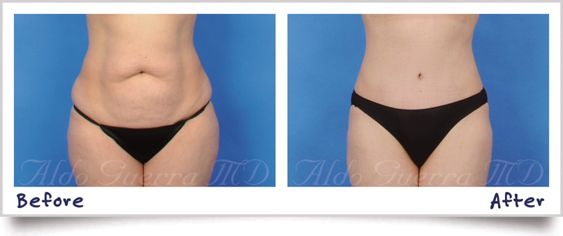 Achieving Better Pain Control with Tummy Tuck Surgery