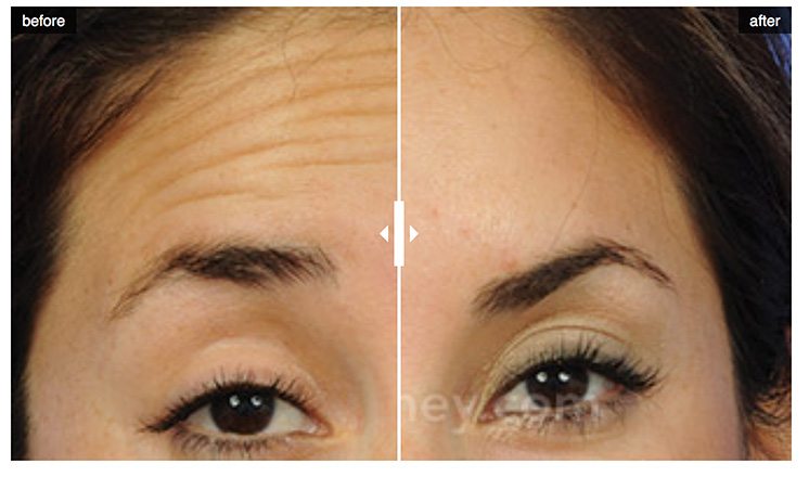 dysport before after forehead injections