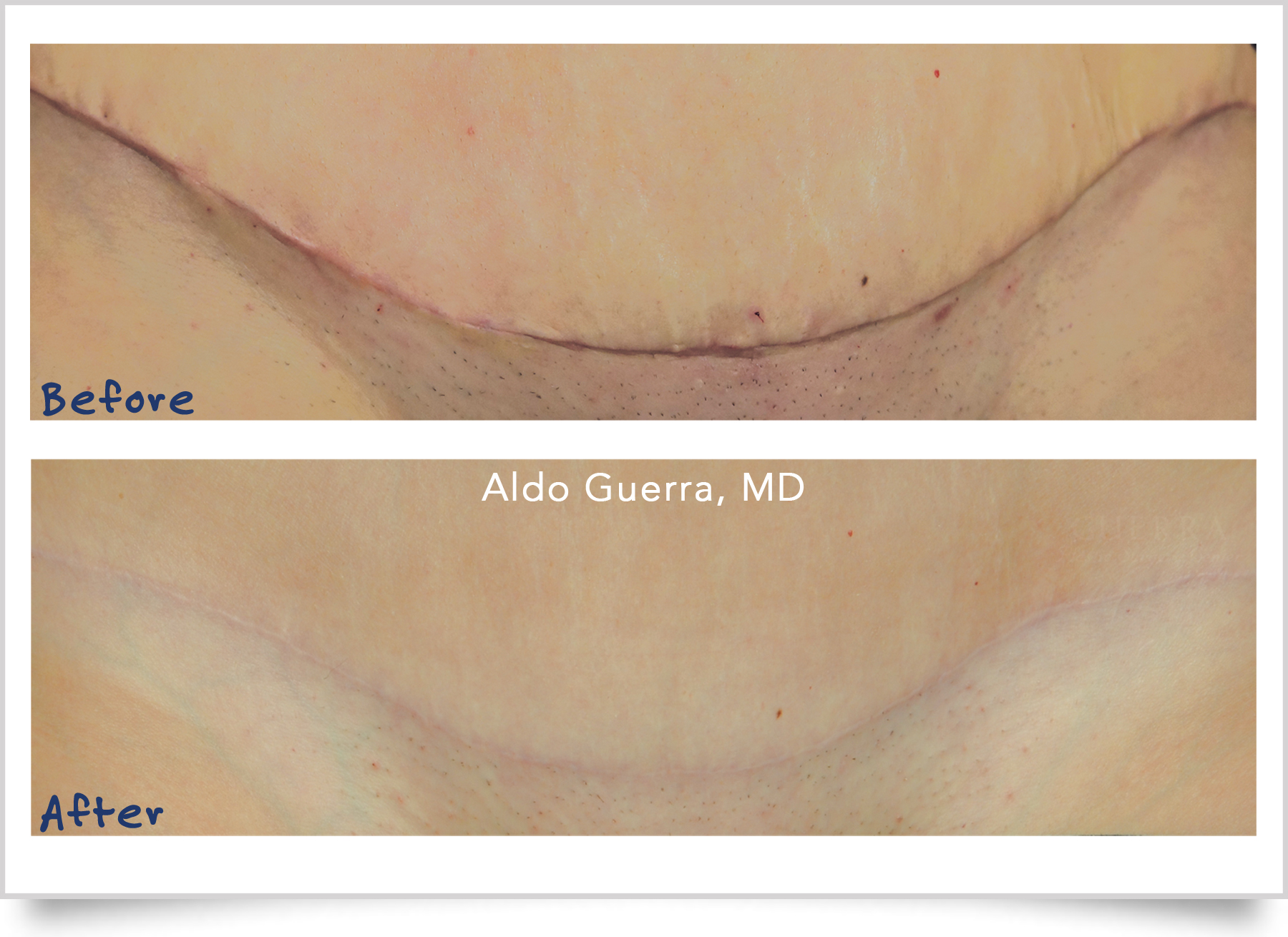 before after tummy tuck incision treated with embrace