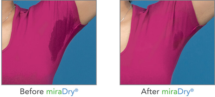 No Sweat, No Problem: How To Get Rid Of Excessive Sweating