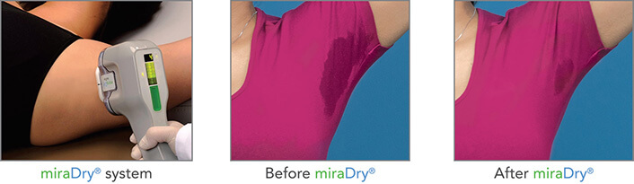 miraDry armpit sweat reduciton