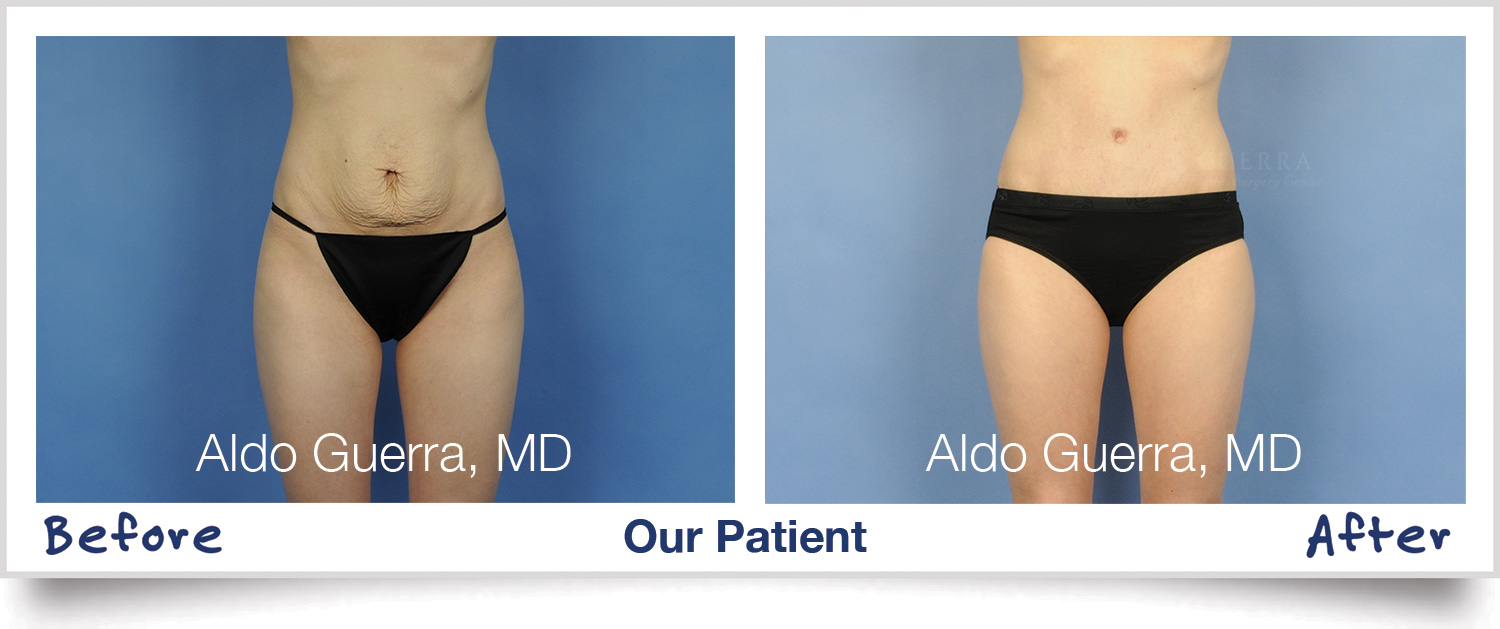 Maintaining Your Weight After a Tummy Tuck