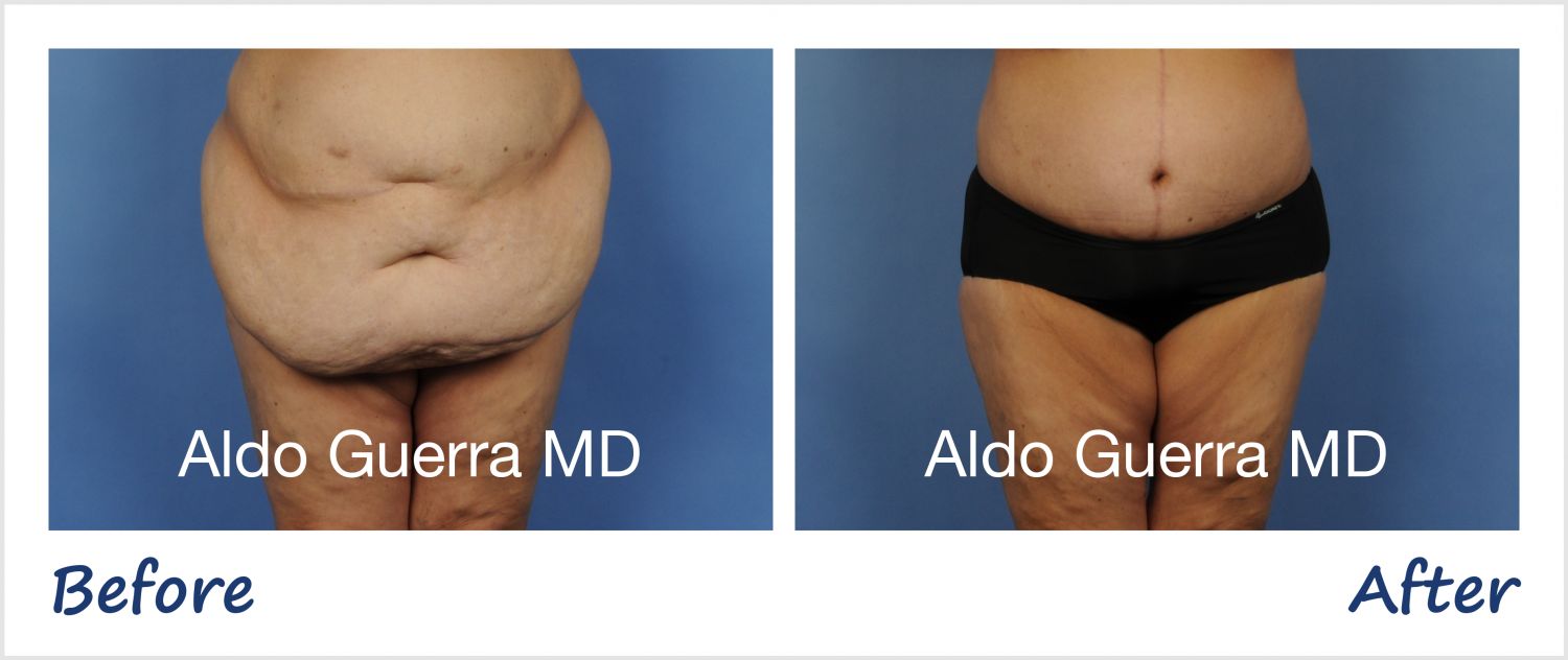 Fleur-De-Lis Abdominoplasty: Tighten and Contour Your Tummy