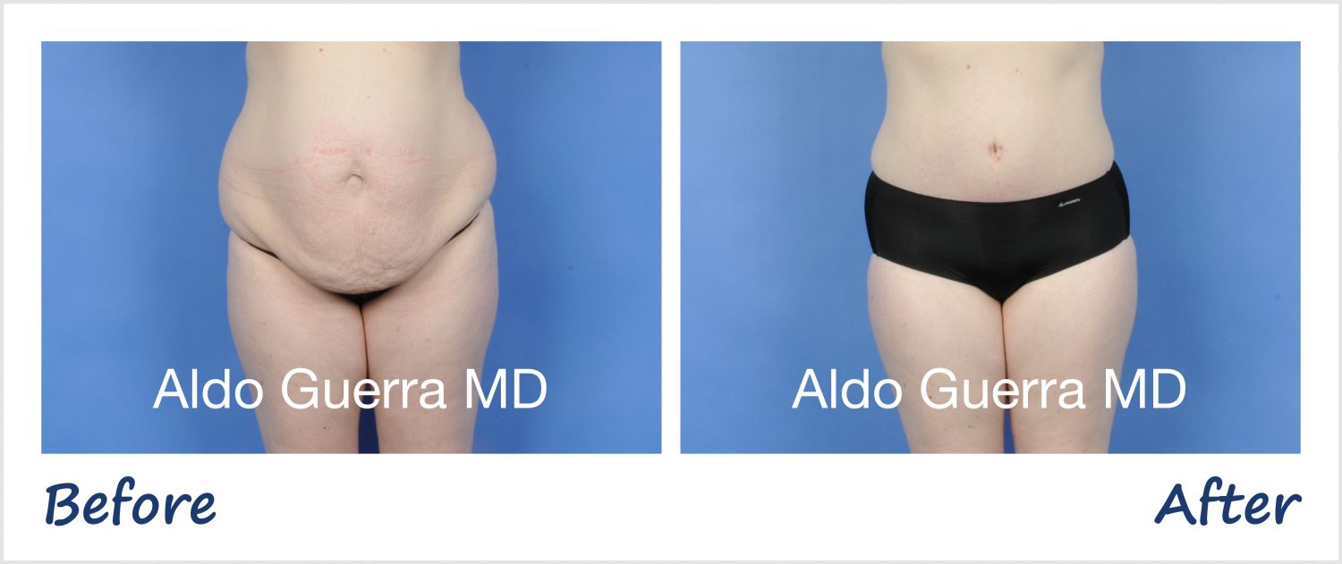 Guerra Plastic Surgery University: Tummy Tuck Educational Series on Visceral Fat